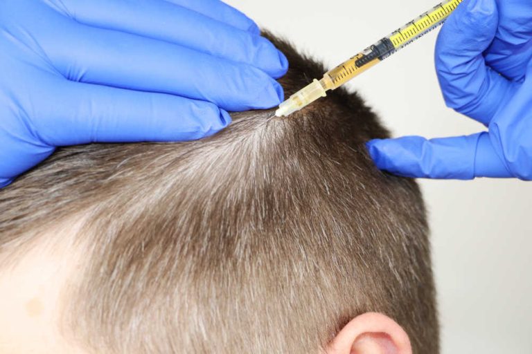 5 razones por las que realizarte un trasplante capilar