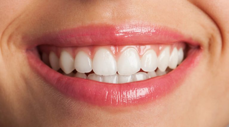Blanqueamiento dental y sus posibilidades